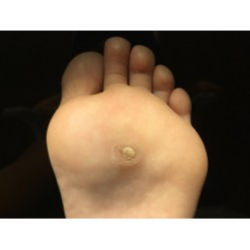 INFECCIÓN POR VPH EN EL PIE - CÓRDOBA